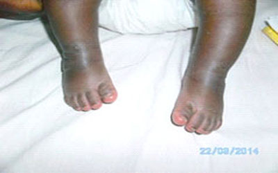 Cameroon Clubfoot Care