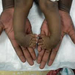 Cameroon Clubfoot Care