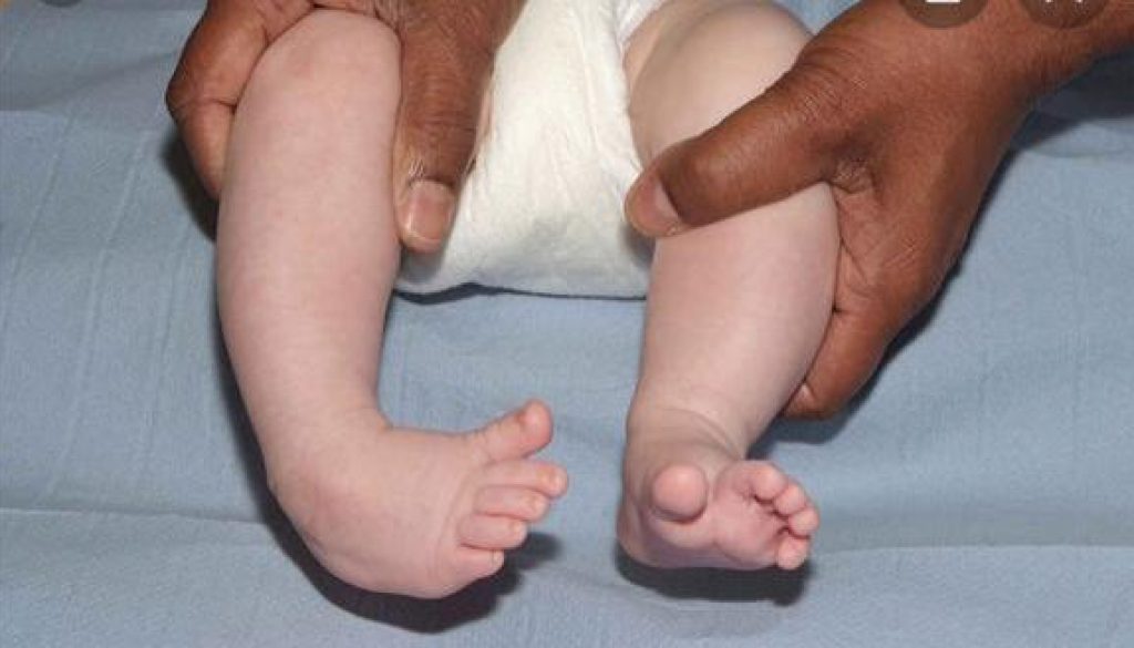 At a young age, clubfeet can be corrected using the ponsetti method