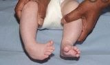At a young age, clubfeet can be corrected using the ponsetti method